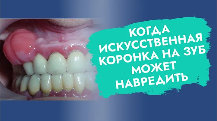 Коронки на зубы. Вред и польза. Показания и противопоказания.